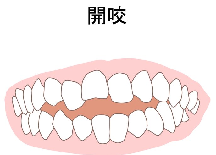 開咬 前歯 噛めない